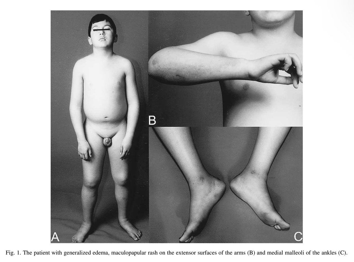 alb_giraldo's tweet photo. #Edema is a rare but well-known clinical manifestation of #dermatomyositis (DM), and it is usually limited to periorbital and distal extremity areas. However, some patients can develop generalized edema or #anasarca, corresponding the majority of published cases to juvenile DM.
The mechanisms underlying juvenile DM with severe subcutaneous and diffuse edema is unclear, but inflammation of adjacent #muscle tissue or coexistence of #vasculitis has been suggested. Other additional mechanisms could the excessive vascular permeability in muscle and subcutaneous tissue as a result of the deposition of immune complexes, complement activation and vascular endothelial damage may eventually result in severe edema.
*Karabiber H, Aslan M, Alkan A, Yakinci C. A rare complication of generalized edema in juvenile dermatomyositis: a report of one case. Brain Dev. 2004;26(4):269-272.
🔗https://t.co/LgXNvESQg8