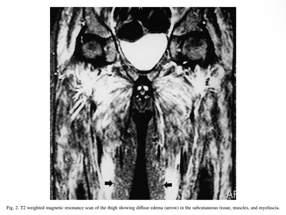 alb_giraldo's tweet photo. #Edema is a rare but well-known clinical manifestation of #dermatomyositis (DM), and it is usually limited to periorbital and distal extremity areas. However, some patients can develop generalized edema or #anasarca, corresponding the majority of published cases to juvenile DM.
The mechanisms underlying juvenile DM with severe subcutaneous and diffuse edema is unclear, but inflammation of adjacent #muscle tissue or coexistence of #vasculitis has been suggested. Other additional mechanisms could the excessive vascular permeability in muscle and subcutaneous tissue as a result of the deposition of immune complexes, complement activation and vascular endothelial damage may eventually result in severe edema.
*Karabiber H, Aslan M, Alkan A, Yakinci C. A rare complication of generalized edema in juvenile dermatomyositis: a report of one case. Brain Dev. 2004;26(4):269-272.
🔗https://t.co/LgXNvESQg8