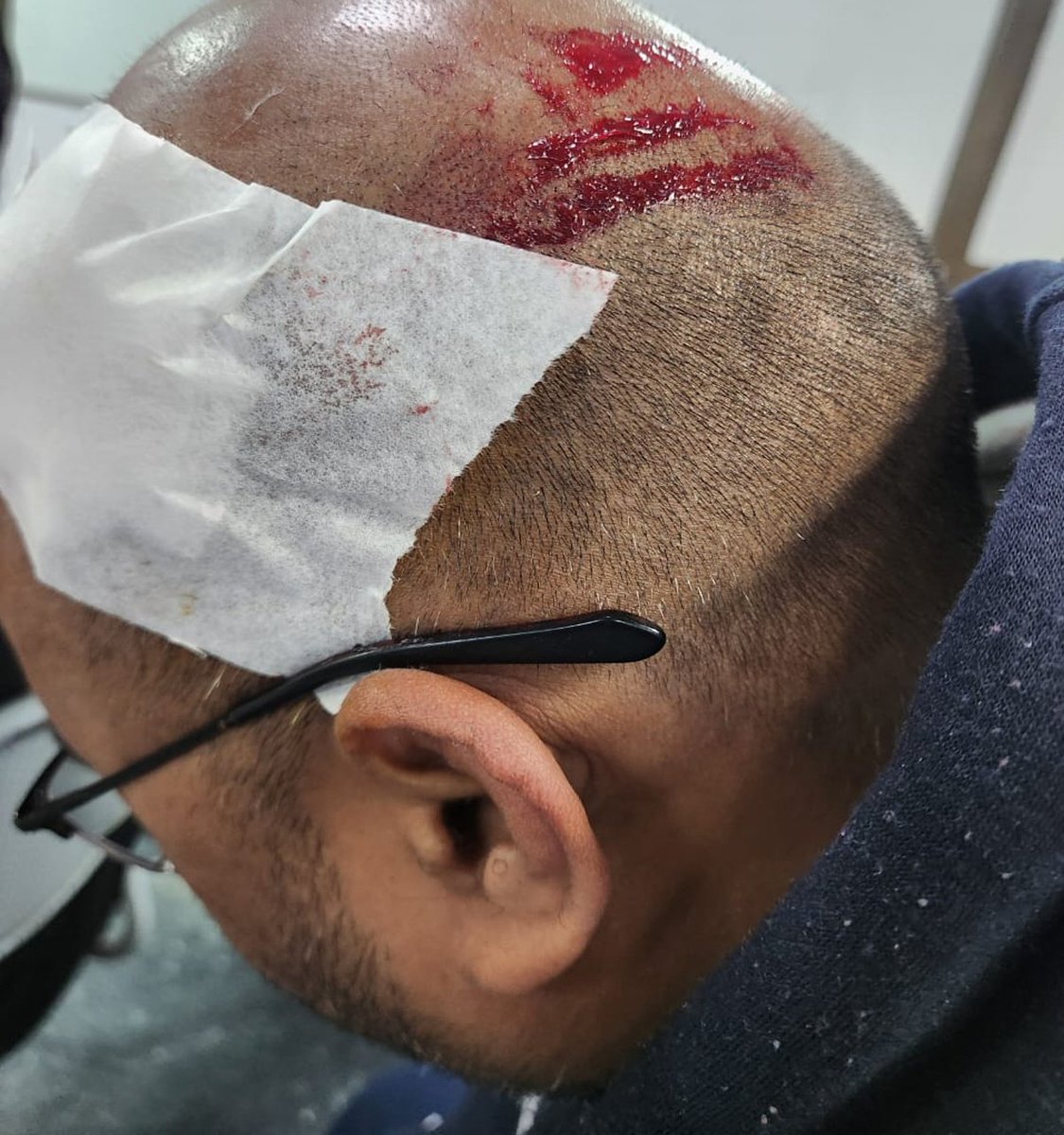 NCMIndiaa's tweet image. Indian Men are not safe inside their own home.
Shyam from Jaitpur (Near Badarpur, Delhi) was brutally assaulted by his wife and Brother in Law last night. When he went to Jaitpur Police Station they simply asked him to go to AIIMS  Trauma Centre to get his MLC and treatment done.…