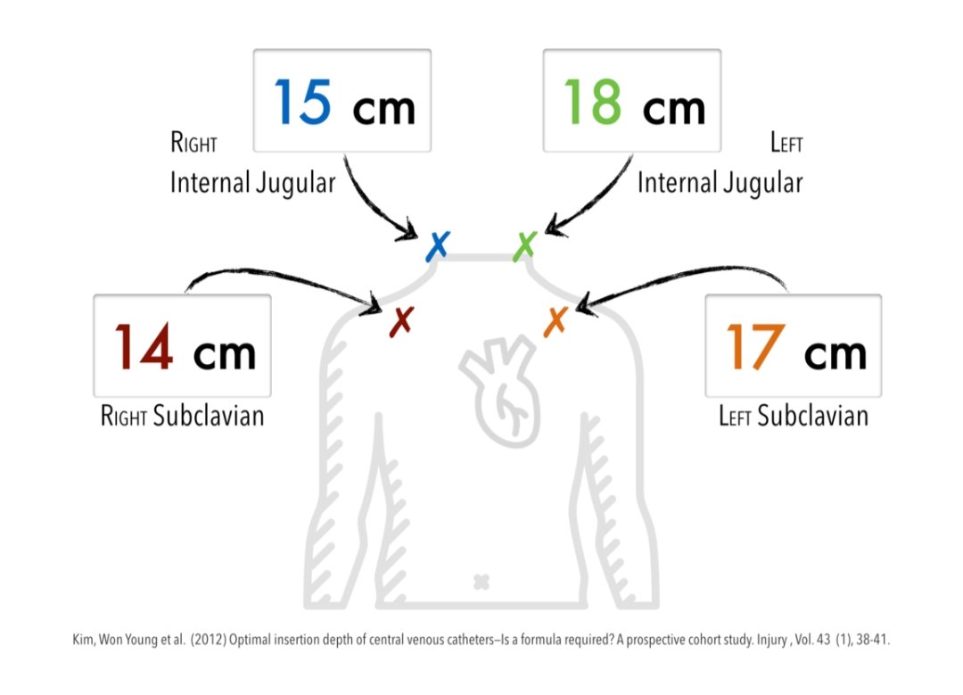 DocPeriop's tweet photo. Recommended length of insertion of CVC based on the vessel being canulated.
(Consider patient's built n musculature) https://t.co/UCpZlqSOv2