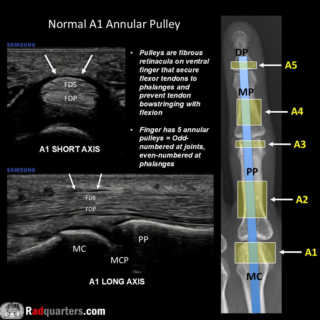 Daniel Kowal, MD, RMSK | Radquarters (@radquarters) on Twitter photo Ultrasound of normal A1 annular pulley. Watch📽️to learn more: bit.ly/tfinger. FDS = Flexor digitorum superficialis tendon. FDP = Flexor digitorum profundus tendon.
#FOAMrad #FOAMed #mskrad #usrad #radres #radtech #medstudent #radquarters <a href="/BostonImaging/">Boston Imaging</a> <a href="/SamsungHealth/">Samsung Healthcare</a> Ultrasound of normal A1 annular pulley. Watch📽️to learn more: bit.ly/tfinger. FDS = Flexor digitorum superficialis tendon. FDP = Flexor digitorum profundus tendon.
#FOAMrad #FOAMed #mskrad #usrad #radres #radtech #medstudent #radquarters <a href="/BostonImaging/">Boston Imaging</a> <a href="/SamsungHealth/">Samsung Healthcare</a>