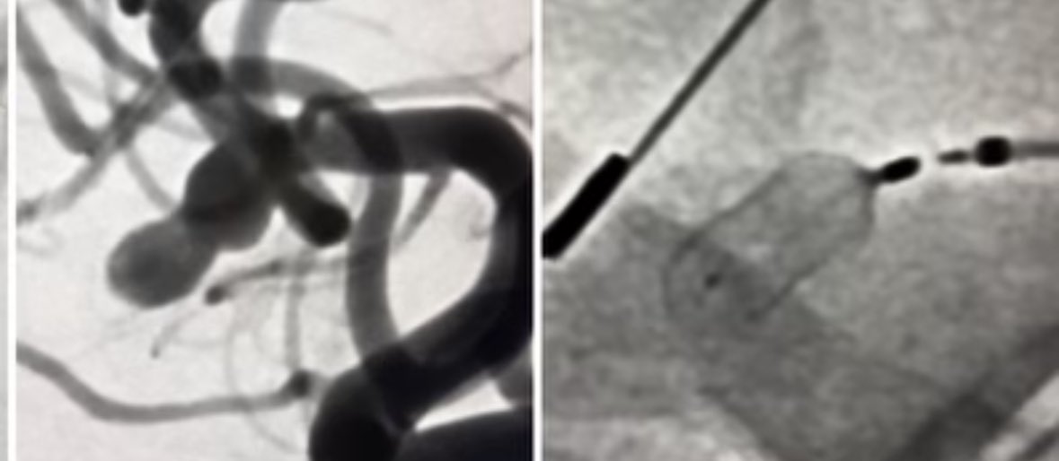 chrispy011's tweet photo. @visishs @Stryker_NV @cvsection @SNISinfo @YoungNIR #JustSEALIT the Galaxy SEAL ARC is designed to conform to the aneurysm shape and stay - (investigational use in the US) - case is a courtesy of @DanTonettiMD https://t.co/mIAnMlcCkL
