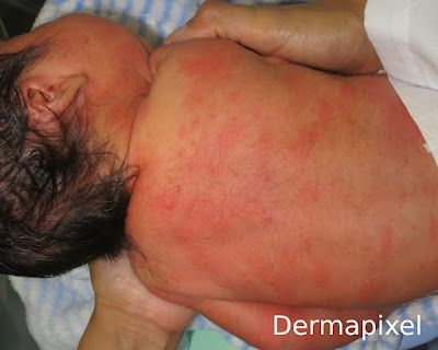SCPed's tweet photo. 🧐Un bebé con manchas rojas, cas clínic pediàtric al blog #Dermapixel de @rosataberner https://t.co/WYvGbxD627 https://t.co/OV4r57Uw51