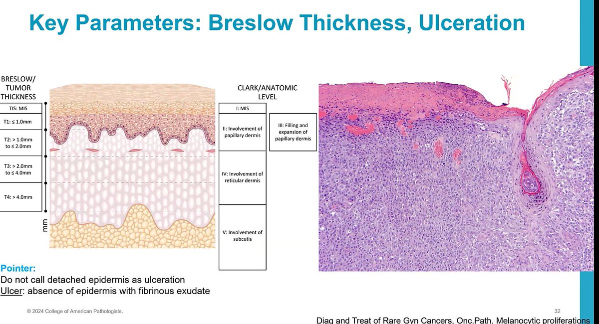 #JobPrepBootcamp #Dermpath
Melanoma-Ulceration
-Do not call detached epidermis as ulceration
Ulcer definition: Absence of epidermis with fibrinous exudate

Dr. Nagarajan #pathology #PathX #Pathtwitter