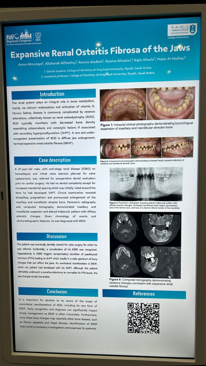 Grateful and proud to be apart of this wonderful team 🤍

- Clinical Case Presentation Award 🥇#SIDC2025 

Many thanks to Dr <a href="/malak_alhadlaq/">Malak</a> for her continuous support and guidance.