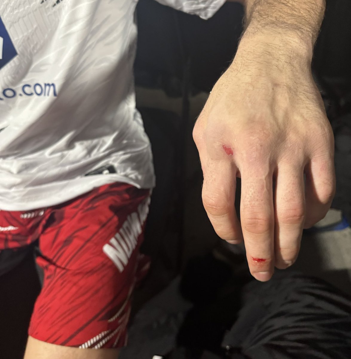 A picture of Umar Nurmagomedov’s right hand that has significant swelling. 😳
