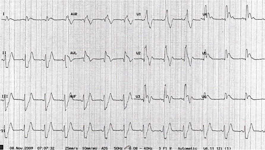23-year-old with syncope, severe distress, and a cryptic ECG. A race against time to uncover a deadly diagnosis. Can you spot the clues to a massive PE? Dive in and decode the mystery. litfl.com/electrocardiog…
#MedEd #FOAMed #CardioTwitter