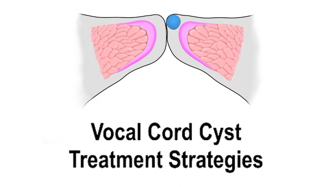 Vocal Cord Cyst Treatment Strategies  (Voice Therapy &amp; Microflap Surgical Removal) youtu.be/u69pnXE5aTo