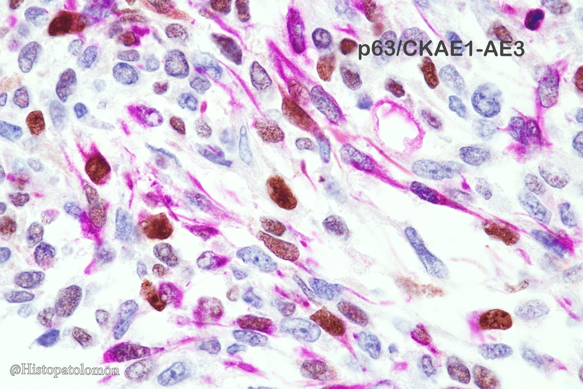 Histopatolomon's tweet photo. Curious #ICH of metaplastic spindle cell carcinoma of the breast. Cells staining with CKAE1/AE3 do not always coincide with those staining with p63. #ihcpath #Breastpath #Pathology #metaplastic #breastcancer #MetaplasticCarcinoma #spindlecellcarcinoma #p63 #cytokeratin #carcinoma https://t.co/F1e6Waefpa