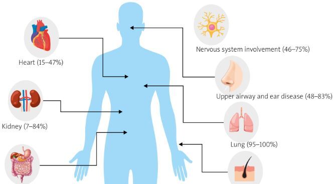 @ReumatologiaJ (@reumatologiaj) on Twitter photo 🔥A NEW comprehensive review on #EGPA
#ANCA-associated #vasculitis by Joanna Kosałka-Węgiel <a href="/RheumKrakow/">Rheumatology & Immunology, Jagiellonian University</a> and Agata Sebastian.
A must-read for rheumatology specialists!
👉bit.ly/3PId6RR 🔥A NEW comprehensive review on #EGPA
#ANCA-associated #vasculitis by Joanna Kosałka-Węgiel <a href="/RheumKrakow/">Rheumatology & Immunology, Jagiellonian University</a> and Agata Sebastian.
A must-read for rheumatology specialists!
👉bit.ly/3PId6RR
