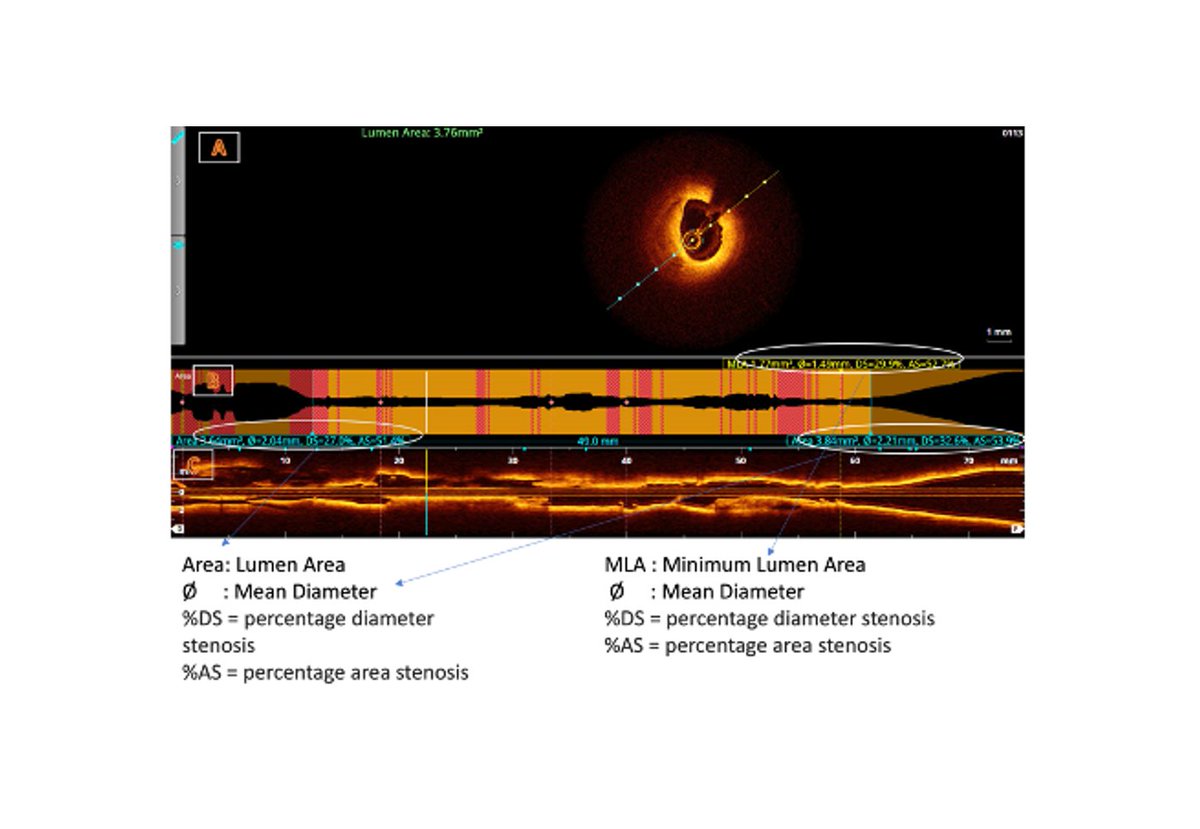Optical Coherence Tomography in the Peripheral Vasculature Jha Manvendu,  DrNB; Ajay Dabas, MBBS, MS, DNB; Brijesh Kanti Biswas, MBBS  https://t.co/aaFdYymnlr @hmpVDM #cardiotwitter
