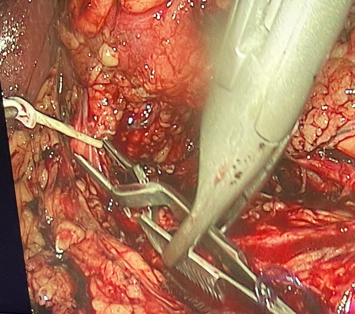 Laparoscopic partial nephrectomy of 2 left renal masses