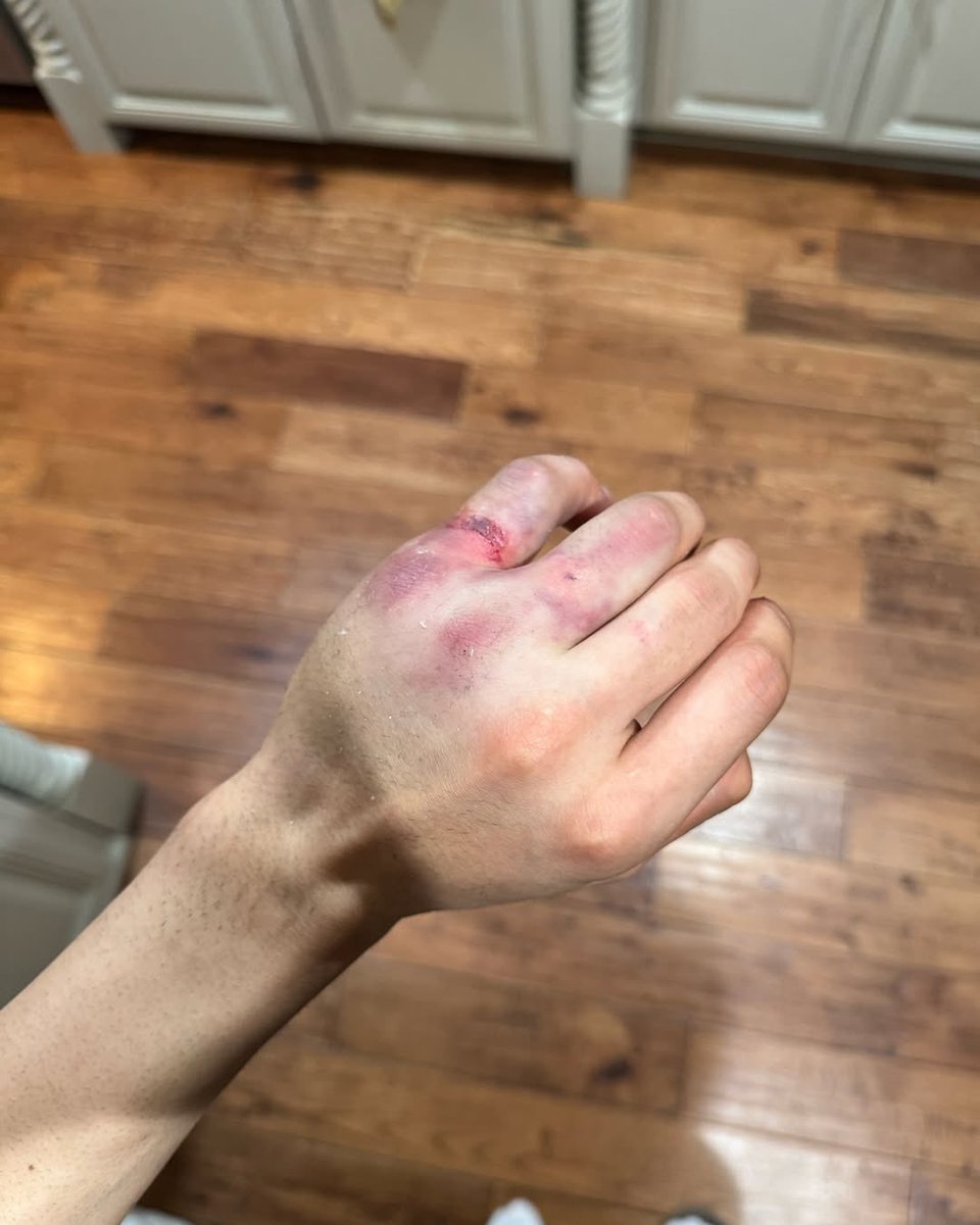 How did Jo even ride?! 🤯

(Via Jo Shimoda/IG)

#SMX #SupercrossLIVE