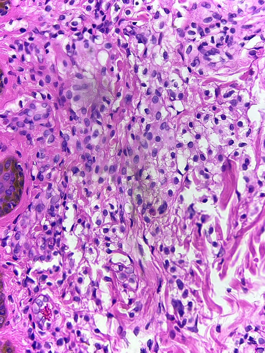Immanuel_Paul30's tweet photo. 50s/F
Multiple cutaneous maculopapular lesions
Thoughts 💭
#dermpath #pathologist #PathTwitter #surgicalpath #oncopath #imanpath https://t.co/NUX2Ayf3Ju
