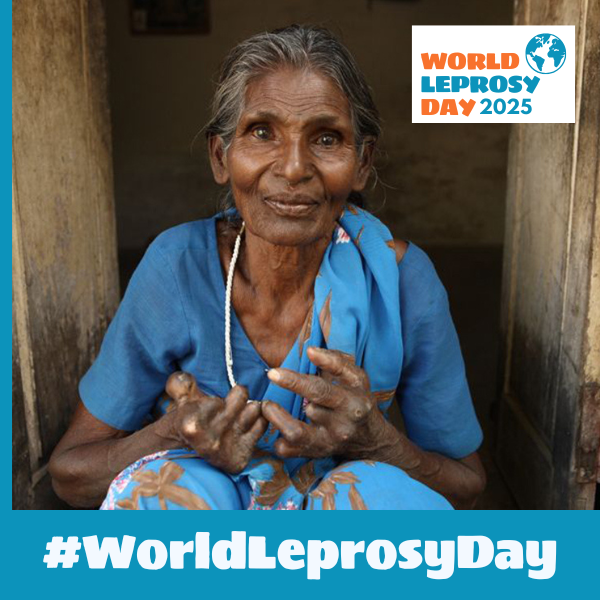 Rehabilitation is essential for people who have been disabled by leprosy. But a combination of scarcity, poverty and discrimination block access to mainstream rehabilitation services. Let’s advocate for inclusion &amp; break the barriers. #WorldLeprosyDay #ActNow #ZeroDiscrimination