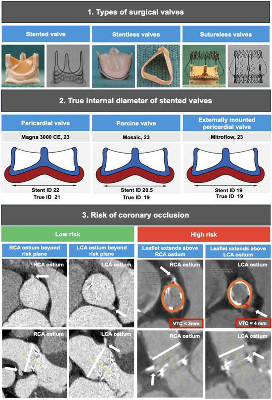 JCM MDPI (@jcm_mdpi) on Twitter photo #mdpijcm
💥Check out the Review #coronary_obstruction
#Aortic Valve-in-Valve Procedures: Challenges and Future Directions
👀mdpi.com/2908972
by Dr. Mariama Akodad et al. <a href="/myriam_akodad/">AKODAD Myriam</a> #mdpijcm
💥Check out the Review #coronary_obstruction
#Aortic Valve-in-Valve Procedures: Challenges and Future Directions
👀mdpi.com/2908972
by Dr. Mariama Akodad et al. <a href="/myriam_akodad/">AKODAD Myriam</a>