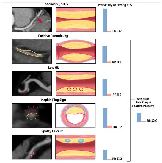 Tomography_MDPI's tweet image. 🖼New study reveals prevalence and significance of non-calcified coronary artery plaque on coronary CT angiogram. Essential insights for cardiovascular health! 🫀 #Cardiology #HealthResearch #CTAngiogram @WVUMedSchool @WVUMedicineHeart
brnw.ch/21wQ7zw
