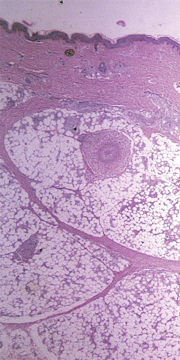 AJDP_Journal's tweet photo. #WhatsNewInDermpath
Lucio Phenomenon (LPh) : A review
https://t.co/SzZH8A2Dsi
Histopathologically, LPh represents a necrotizing panvasculitis, ischemic necrosis, and the presence of immune components in small vessels. https://t.co/9gPiCJAjGK