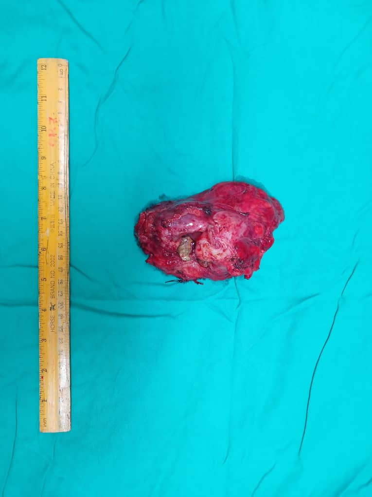 William_OLK's tweet photo. Successfully navigated a complex case of xanthogranulomatous pyelonephritis with an open nephrectomy. Prioritizing patient outcomes, even in the era of advanced robotic technology. https://t.co/1ZxGdE0Yhz
