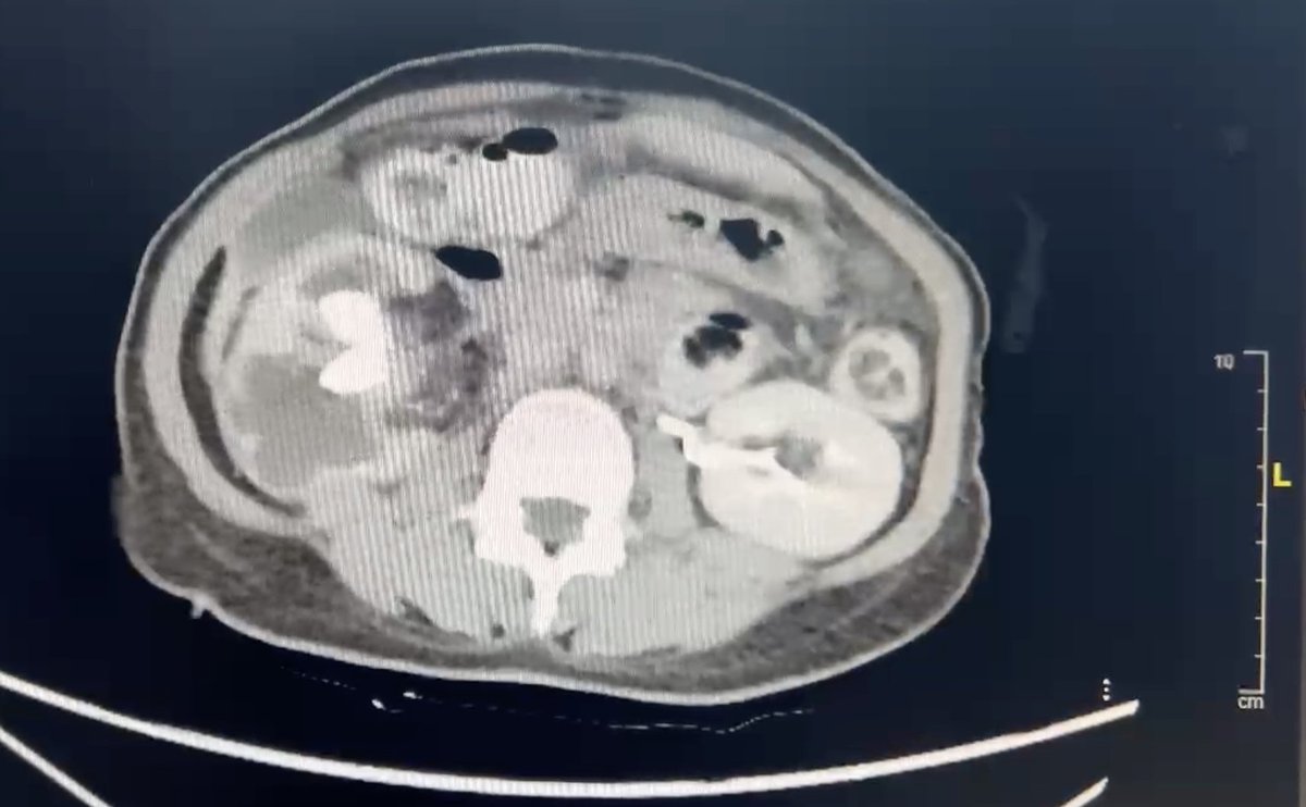 William_OLK's tweet photo. Successfully navigated a complex case of xanthogranulomatous pyelonephritis with an open nephrectomy. Prioritizing patient outcomes, even in the era of advanced robotic technology. https://t.co/1ZxGdE0Yhz
