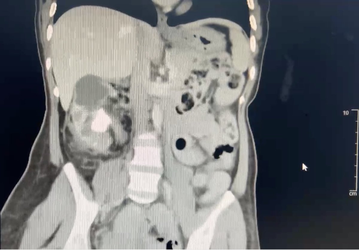 William_OLK's tweet photo. Successfully navigated a complex case of xanthogranulomatous pyelonephritis with an open nephrectomy. Prioritizing patient outcomes, even in the era of advanced robotic technology. https://t.co/1ZxGdE0Yhz