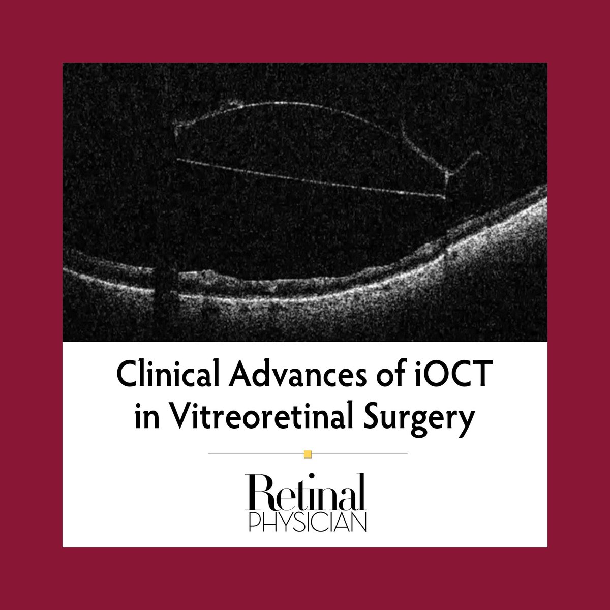 RetinalPhys's tweet image. Innovations in intraoperative OCT technology are shaping vitreoretinal surgery in significant ways. Read more: ow.ly/5Yqm50UB1OK
#RetinalPhysician #retinasurgery #iOCT #imaging #Conexiant