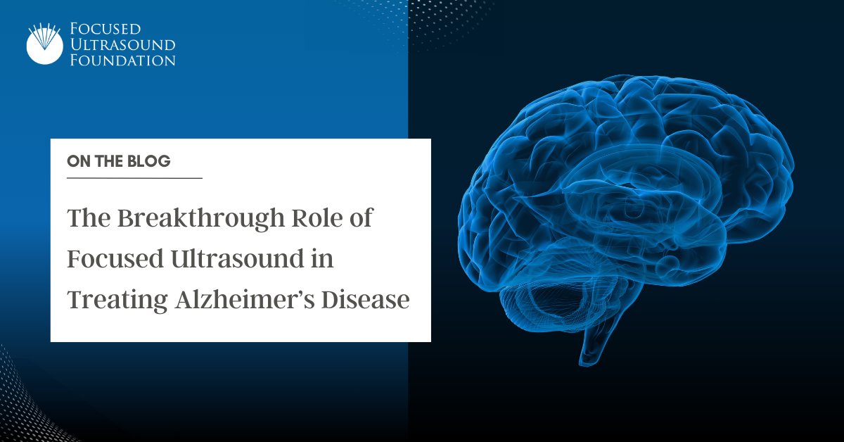 In this month’s blog, Suzanne LeBlang, MD, a neuroradiologist and the Foundation’s director of clinical relationships, discusses recently published results from a clinical trial using focused ultrasound to treat Alzheimer’s disease (AD). Dr. LeBlang puts the study’s findings in