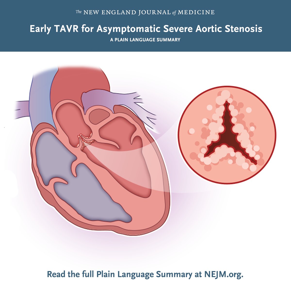 In the EARLY TAVR trial, researchers assessed whether early transcatheter aortic-valve replacement (TAVR) would lead to better outcomes than clinical surveillance in patients with asymptomatic severe aortic stenosis. Full trial results: nej.md/4hjJZRc