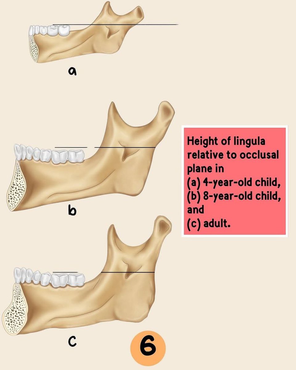 asnan_tbyb's tweet photo. Inferior alveolar Nerve block 

Great 👍 https://t.co/EJu4hIGTBg