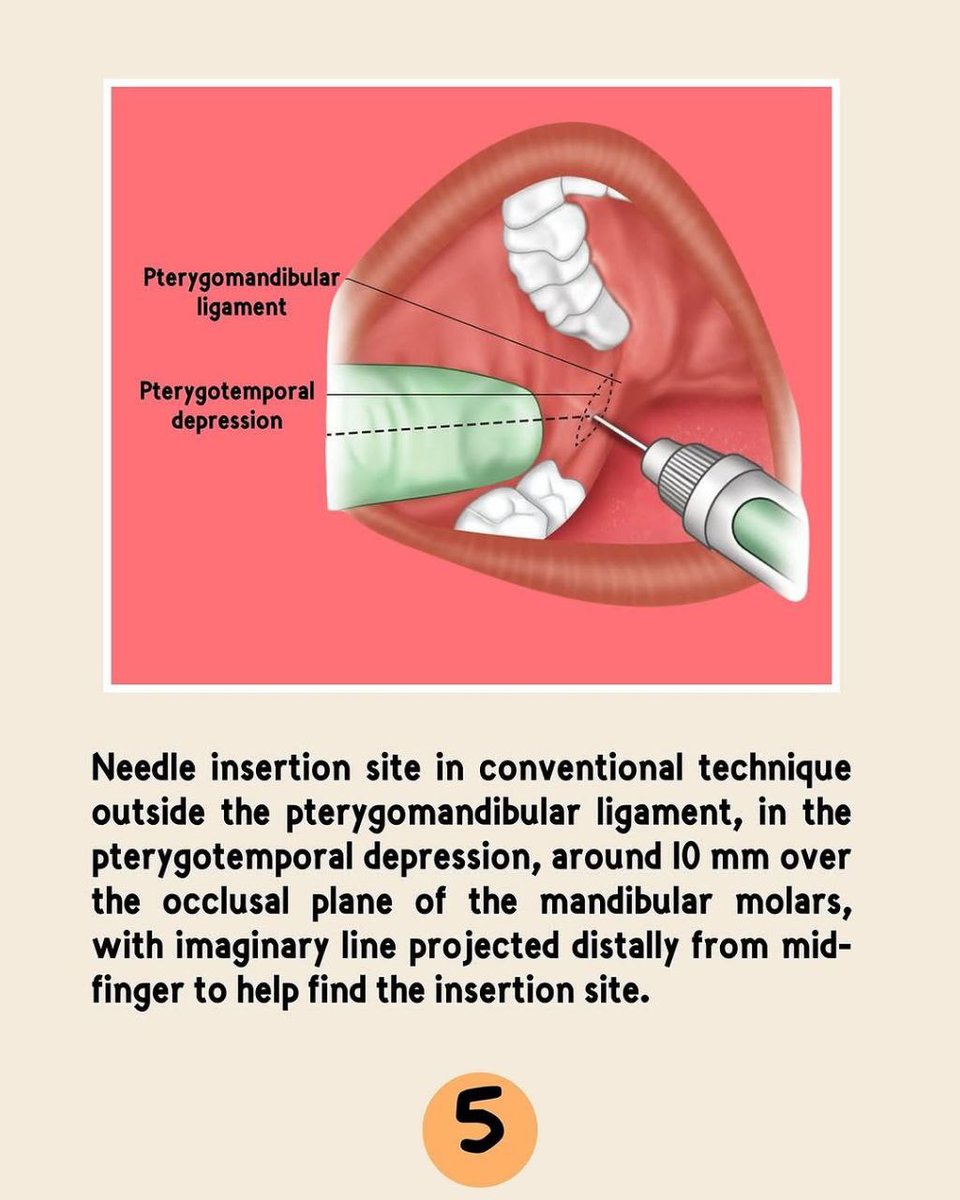 asnan_tbyb's tweet photo. Inferior alveolar Nerve block 

Great 👍 https://t.co/EJu4hIGTBg