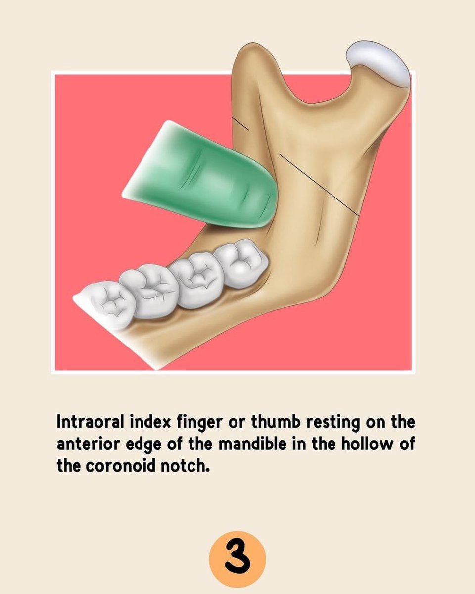 asnan_tbyb's tweet photo. Inferior alveolar Nerve block 

Great 👍 https://t.co/EJu4hIGTBg