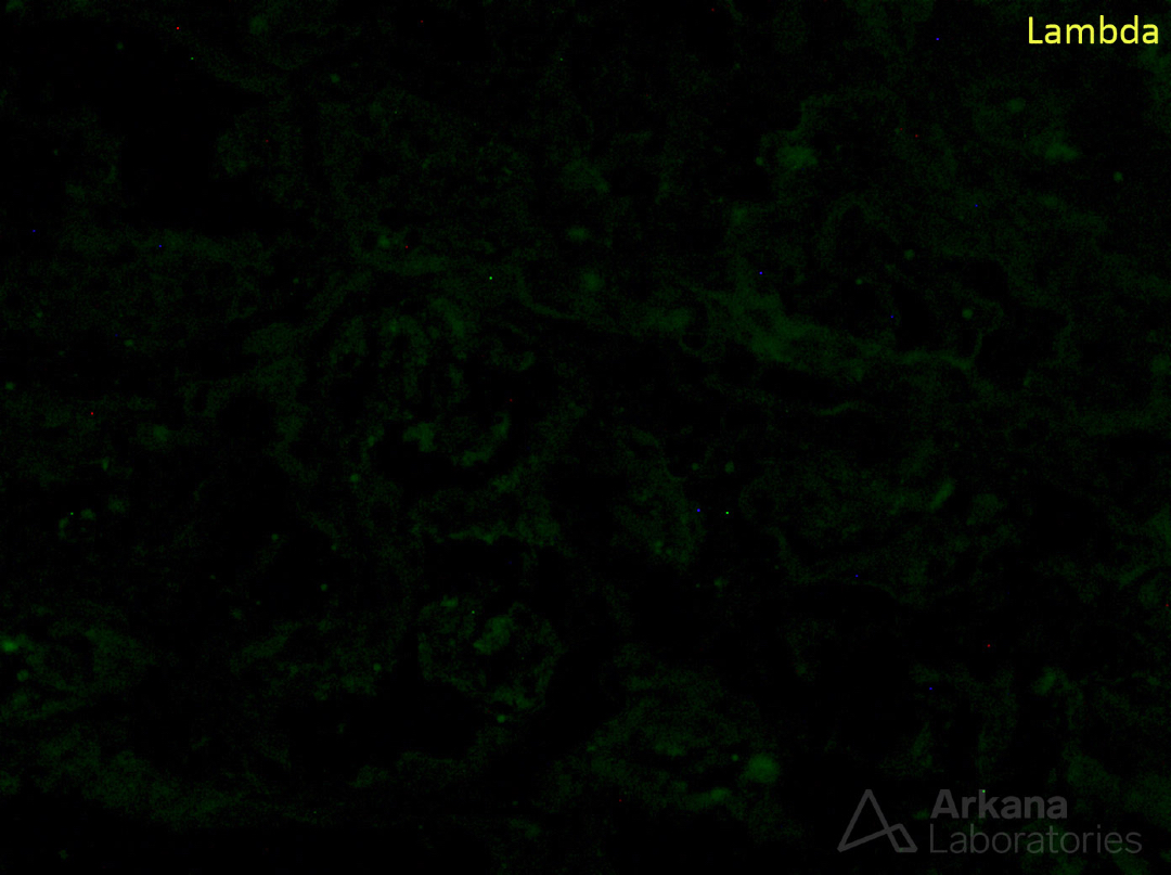 arkanalabs's tweet image. What is your diagnosis?

#DiagnoseThis #renalpath #nephropath