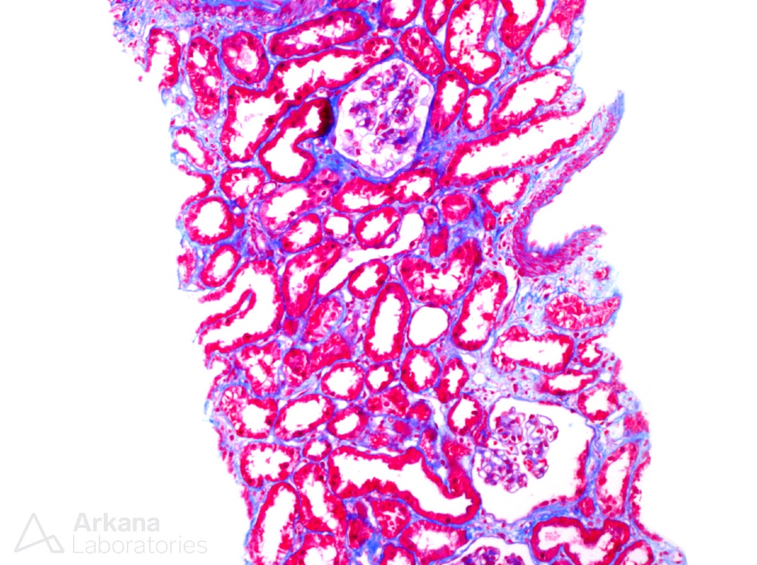arkanalabs's tweet image. What is your diagnosis?

#DiagnoseThis #renalpath #nephropath