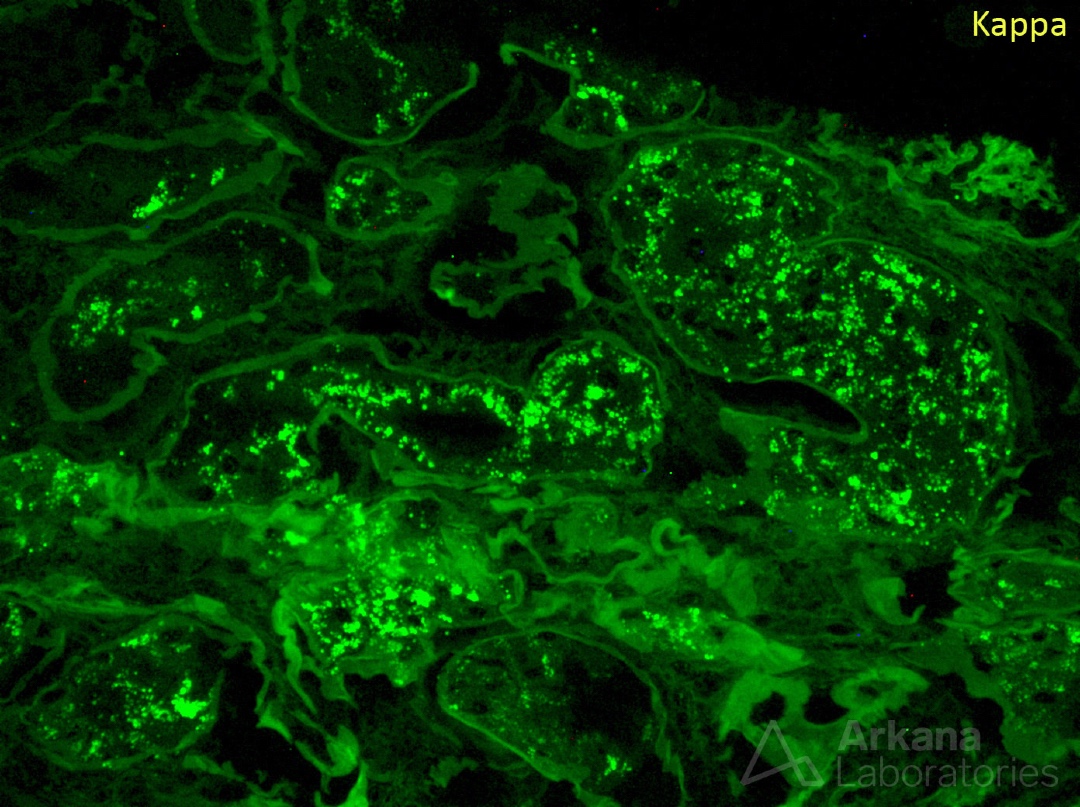 arkanalabs's tweet image. What is your diagnosis?

#DiagnoseThis #renalpath #nephropath