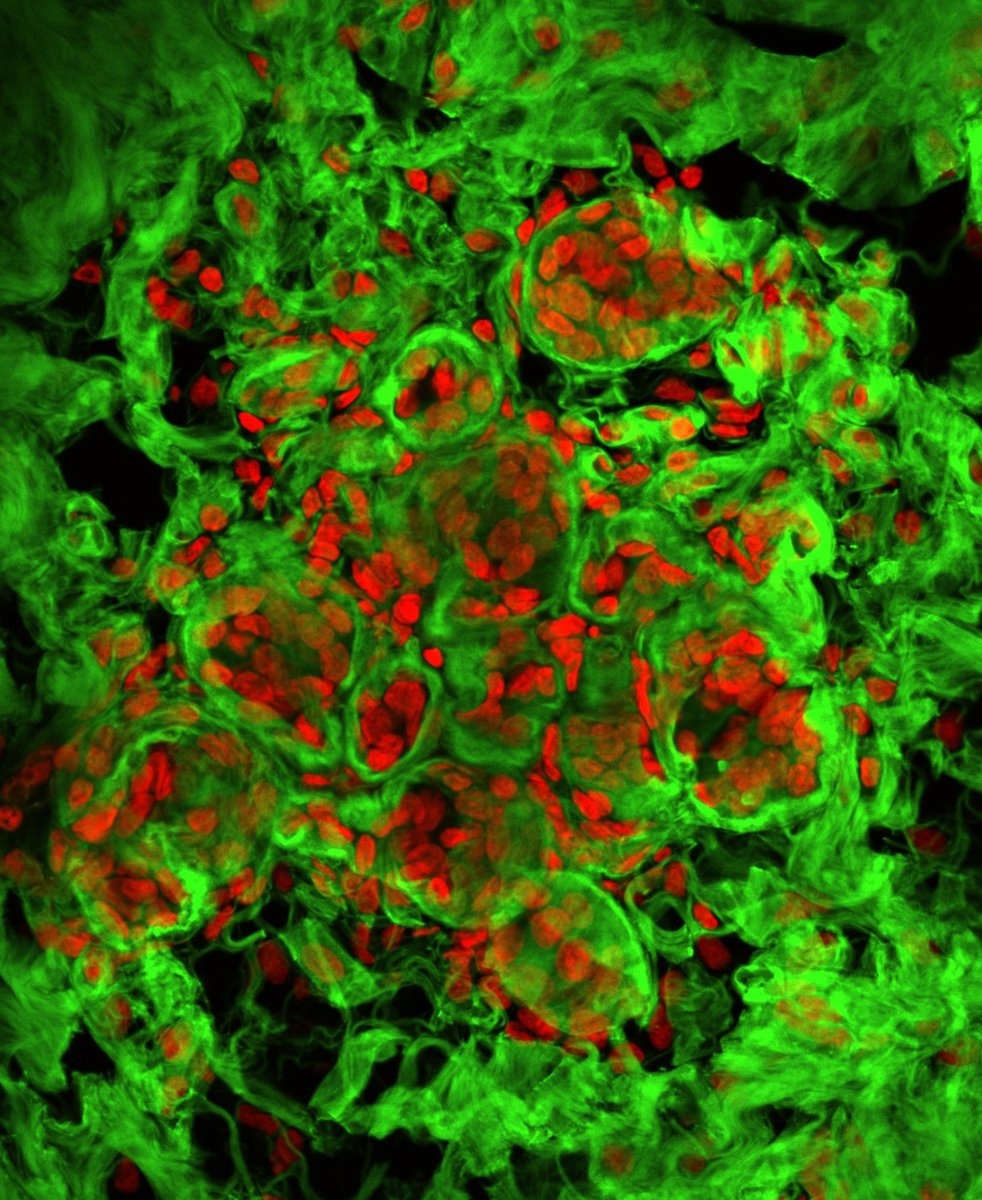 JohannaIEnglund (@johannaienglund) on Twitter photo Are you working on #ECM or mechanobiology in the mammary gland or breast cancer? Together with @JJNorthey we are guest editing a collection of <a href="/Mammary_journal/">Journal of Mammary Gland Biology and Neoplasia</a> and the submission of articles is now open! Submit your research, review or perspective to: link.springer.com/collections/dh… Are you working on #ECM or mechanobiology in the mammary gland or breast cancer? Together with @JJNorthey we are guest editing a collection of <a href="/Mammary_journal/">Journal of Mammary Gland Biology and Neoplasia</a> and the submission of articles is now open! Submit your research, review or perspective to: link.springer.com/collections/dh…