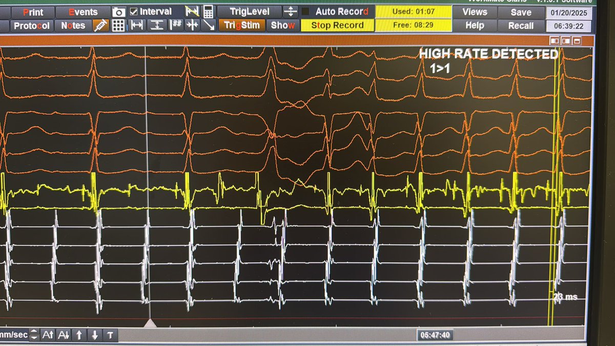 José Miguel Carreño Lineros (@josemig_carreno) on Twitter photo Beautiful EP phenomenon during SVT ablation in HJRJ!👄⚡️ <a href="/teremoraleda/">Teresa_Moraleda</a> <a href="/Irene_Esteve/">Irene Esteve</a> <a href="/Dr_Pmorina/">Dr. Pablo Moriña Vázquez</a> <a href="/Emilioamigo_/">Emilio Amigo</a> Beautiful EP phenomenon during SVT ablation in HJRJ!👄⚡️ <a href="/teremoraleda/">Teresa_Moraleda</a> <a href="/Irene_Esteve/">Irene Esteve</a> <a href="/Dr_Pmorina/">Dr. Pablo Moriña Vázquez</a> <a href="/Emilioamigo_/">Emilio Amigo</a>