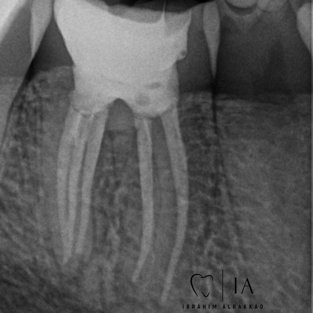 Tooth 46
Dx: previously initiated with SAP (Radix entomolaris)
Tx:RCT
5 canals detected the extra one was Middle distal🔥
Look at the nice anatomy🤩🤩