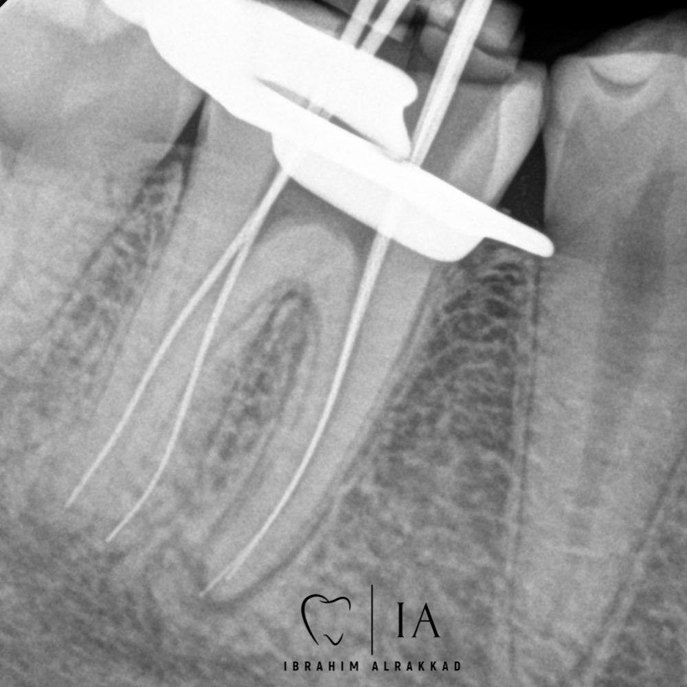 iibra_01's tweet photo. Tooth 46
Dx: previously initiated with SAP (Radix entomolaris)
Tx:RCT
5 canals detected the extra one was Middle distal🔥
Look at the nice anatomy🤩🤩 https://t.co/39jr9VW5HJ