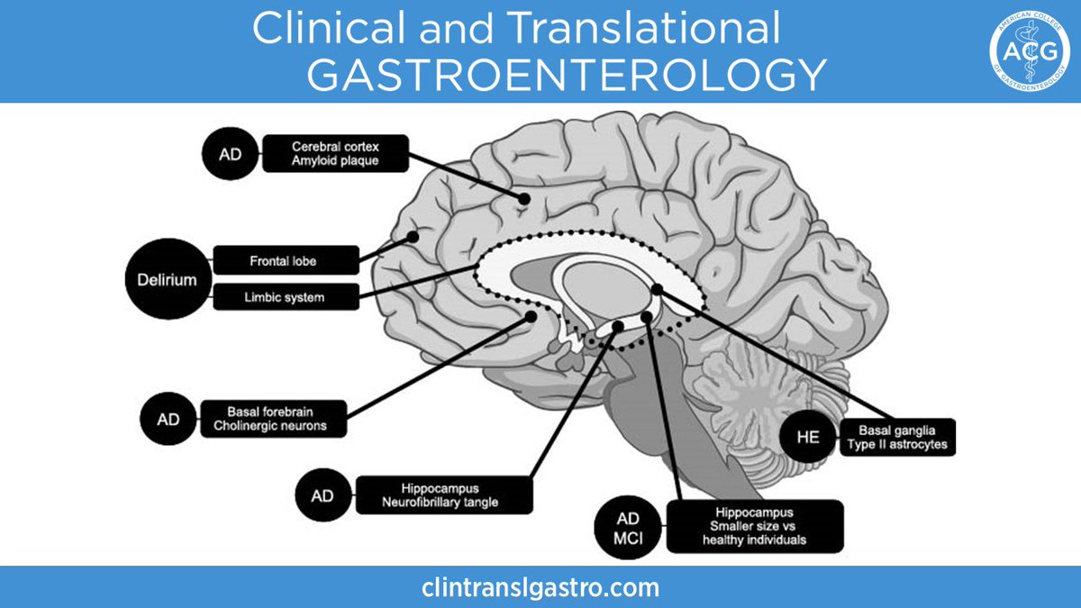 ACG_CTG (@acg_ctg) on Twitter photo In #CTGjournal:
The Misdiagnosis and Underdiagnosis of Hepatic Encephalopathy
Patricia Bloom, MD
➡️ bit.ly/40naxJJ
<a href="/BloomPringle/">Patty Pringle Bloom, M.D.</a> <a href="/AmCollegeGastro/">ACG</a> <a href="/brianjacobsonmd/">Brian Jacobson</a> <a href="/YhernandezMD/">Yasmin Hernandez-Barco, MD</a> <a href="/LevinthalDavid/">David J. Levinthal, MD, PhD</a> <a href="/EugeniaShmidtMD/">Eugenia Shmidt MD</a> <a href="/singal_ashwani/">Ashwani Singal</a> In #CTGjournal:
The Misdiagnosis and Underdiagnosis of Hepatic Encephalopathy
Patricia Bloom, MD
➡️ bit.ly/40naxJJ
<a href="/BloomPringle/">Patty Pringle Bloom, M.D.</a> <a href="/AmCollegeGastro/">ACG</a> <a href="/brianjacobsonmd/">Brian Jacobson</a> <a href="/YhernandezMD/">Yasmin Hernandez-Barco, MD</a> <a href="/LevinthalDavid/">David J. Levinthal, MD, PhD</a> <a href="/EugeniaShmidtMD/">Eugenia Shmidt MD</a> <a href="/singal_ashwani/">Ashwani Singal</a>