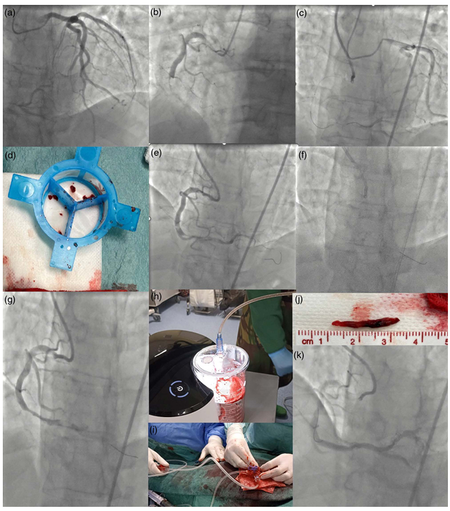 Overcoming thrombus challenges using Penumbra aspiration system connected to Guideliner 7F, in the hands of <a href="/tjcmendonca/">Tiago Mendonça</a> and <a href="/LusAlmeidaMora1/">Luís Almeida Morais</a> at <a href="/HSMarta_Cardio/">Hospital Santa Marta Cardiology</a> 

Find out more about our latest published clinical case at journals.lww.com/coronary-arter…