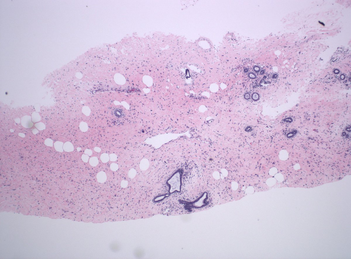 DanGrahamMD's tweet image. 40s F breast mass. Dx/IHC?

#PathTwitter #PathX #BreastPath