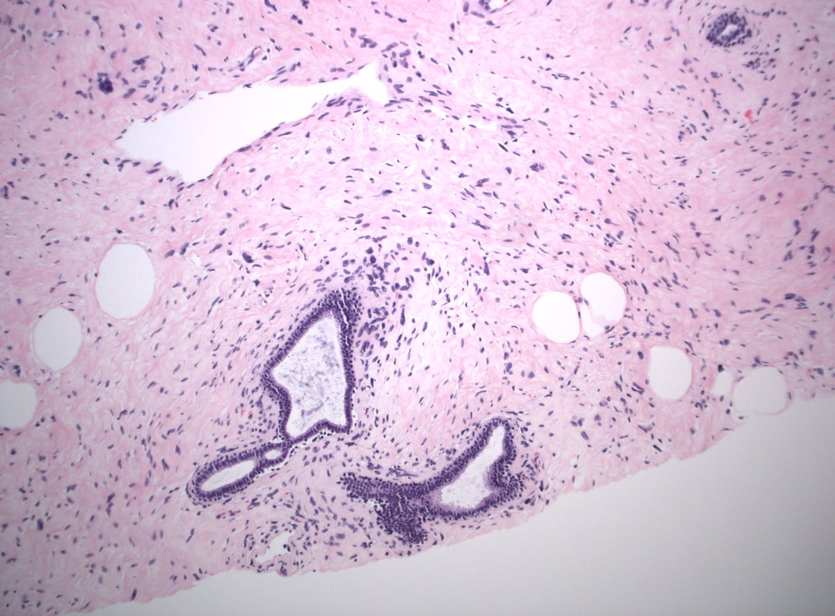 DanGrahamMD's tweet image. 40s F breast mass. Dx/IHC?

#PathTwitter #PathX #BreastPath