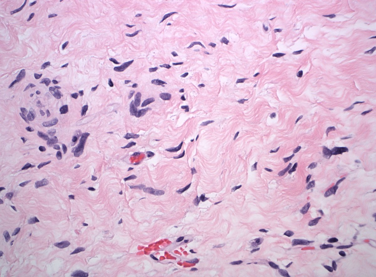 DanGrahamMD's tweet image. 40s F breast mass. Dx/IHC?

#PathTwitter #PathX #BreastPath
