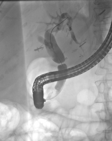 Allison Schulman MD, MPH (@allie_schulman) on Twitter photo beautiful & striking example of a post liver transplant stricture
Teaching point: dilate (if >4 wks out) & serially stent w increasing plastics or SEMS; cholangioscopy can be helpful to define wire trajectory
(shared w permission)
#WomenInEndo <a href="/UMichInterEndo/">University of Michigan Interventional Endoscopy</a> beautiful & striking example of a post liver transplant stricture
Teaching point: dilate (if >4 wks out) & serially stent w increasing plastics or SEMS; cholangioscopy can be helpful to define wire trajectory
(shared w permission)
#WomenInEndo <a href="/UMichInterEndo/">University of Michigan Interventional Endoscopy</a>