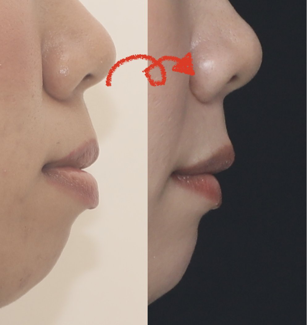 dds_cozy's tweet image. 『矯正治療 』

かなりシビアなケース。
思わず投稿。

MSE + ４本抜歯 + 表側矯正 + アンカー
**MSE + ４本抜歯は珍しい。