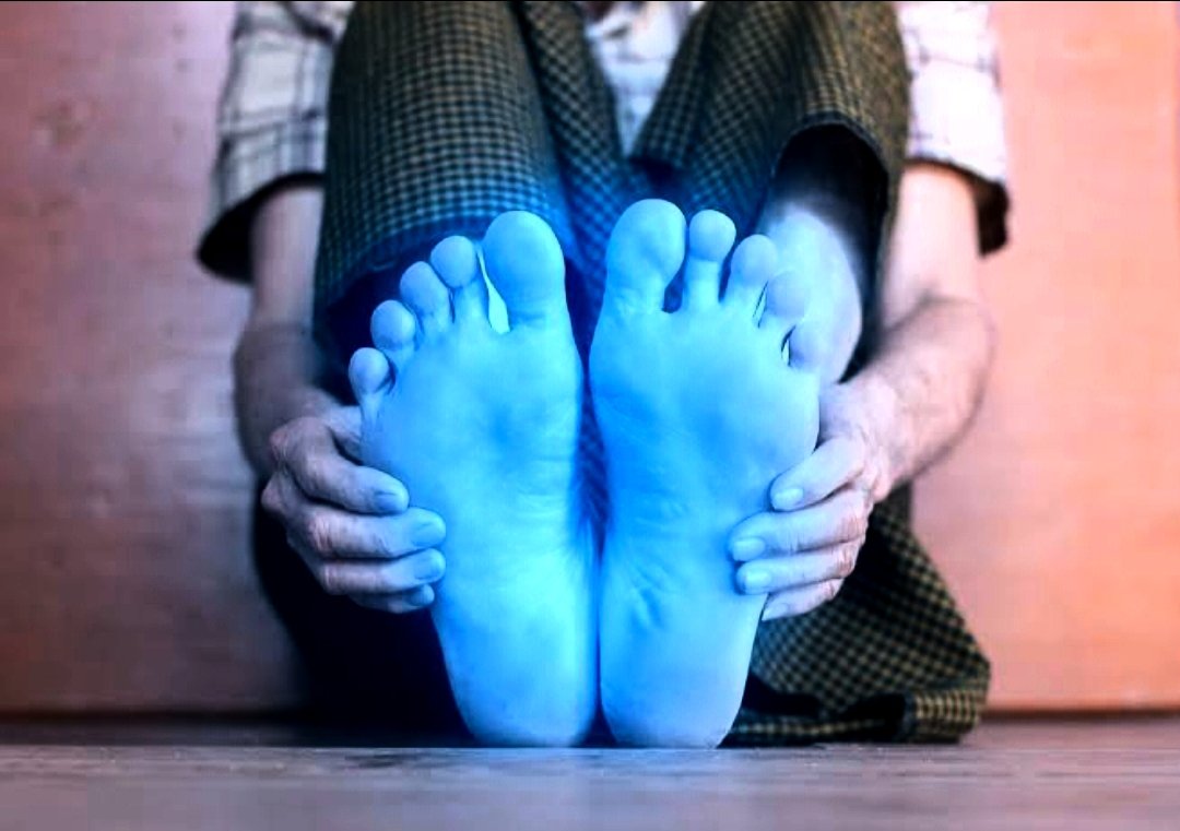 Diafootcareng's tweet image. Are your feet always cold, even in warm rooms? Diabetes can reduce blood flow, making your feet cold or numb. This poor circulation also slows healing from cuts or blisters, which can lead to serious issues. Don&apos;t ignore it!

#DiabeticFootCare  #CirculationMatters #Diafootcare