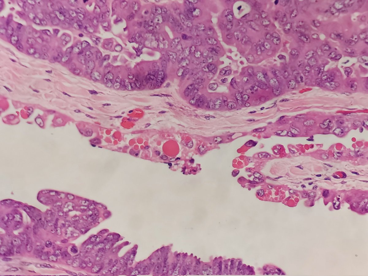 padmapathology1's tweet image. #pathclassic #pathresidents #pathology #gynpath
Hyaline globules in ovarian tumors (post-NACT serous carcinoma)
Other tumors showing them include hepatocellular carcinoma, Kaposi sarcoma, lung adenoca. Benign/ non-neoplastic inc meningioma,inclusion body fibromatosis, pl adenoma