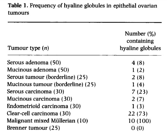 padmapathology1's tweet image. #pathclassic #pathresidents #pathology #gynpath
Hyaline globules in ovarian tumors (post-NACT serous carcinoma)
Other tumors showing them include hepatocellular carcinoma, Kaposi sarcoma, lung adenoca. Benign/ non-neoplastic inc meningioma,inclusion body fibromatosis, pl adenoma