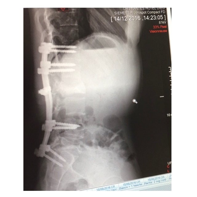 Laureline_Chtrt's tweet photo. En 2016, Candice est violemment écrasée par une voiture. Moëlle épinière écrasée, poumons perforés, bras cassé... L'assurance de la conductrice responsable n'indemnise tjs pas, presque 10 ans après. On fait tout pour l'aider ce matin dans @M6 et @RTLFrance ! https://t.co/rnhohUHonc