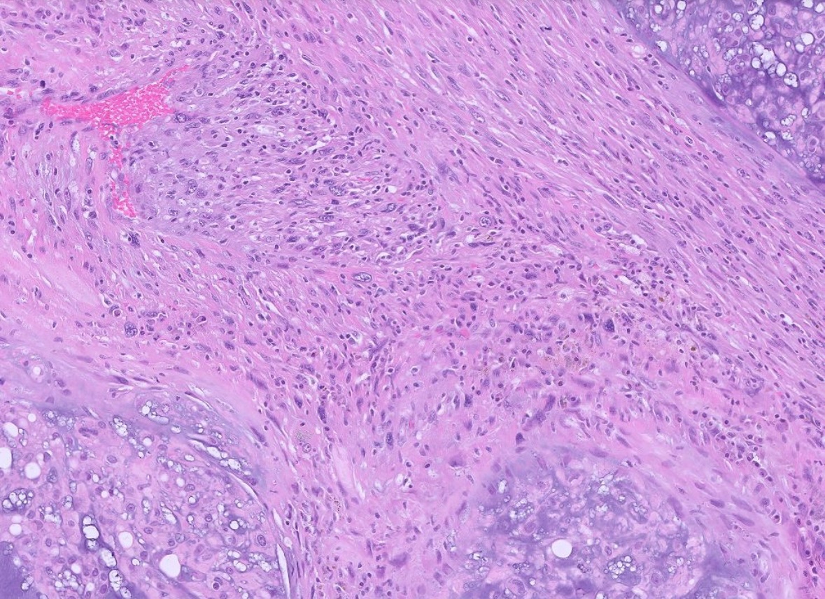 neuropathology's tweet image. Dedifferentiated chordoma, metastatic to the lung.  Without clinical hx, these can be very difficult to recognize, as Brachyury often negative (as it is here). #pathtwitter #pathx #cnspath #neuropath #neuropathology
